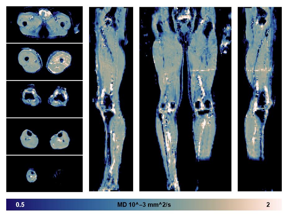 IVIM corrected whole leg muscle mean diffusivity obtained from diffusion tensor imaging.